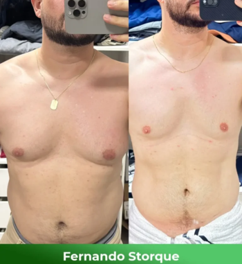 Fernando-Storque-Antes-e-depois-1-768x864-1-2.webp